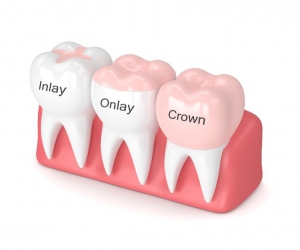 Types of dental crowns