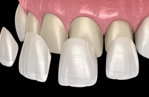 Are veneers permanent?