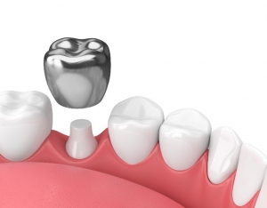 What is a dental crown
