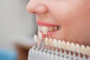 Are there different types of veneers?