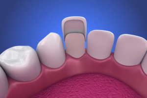 How do veneers work?
