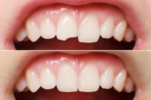 WHAT IS TOOTH BONDING?