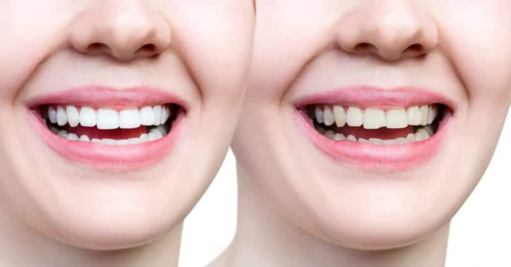 TEETH BONDING EVERYTHING YOU NEED TO KNOW ABOUT THE PROCEDURE
