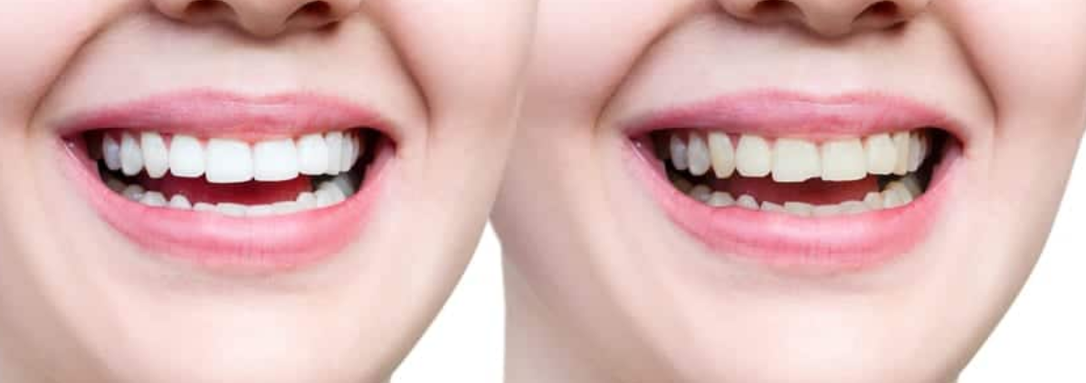 TEETH BONDING: EVERYTHING YOU NEED TO KNOW ABOUT THE PROCEDURE