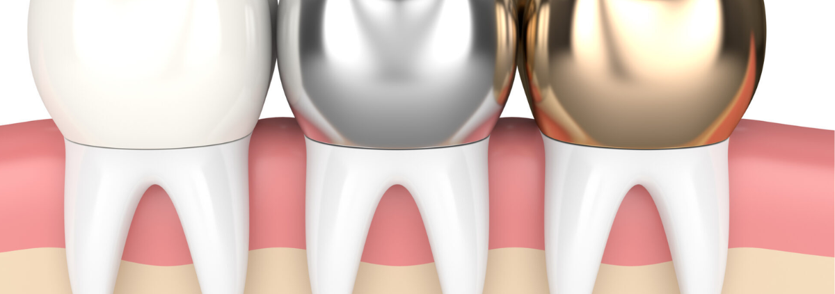 The durability of dental crowns
