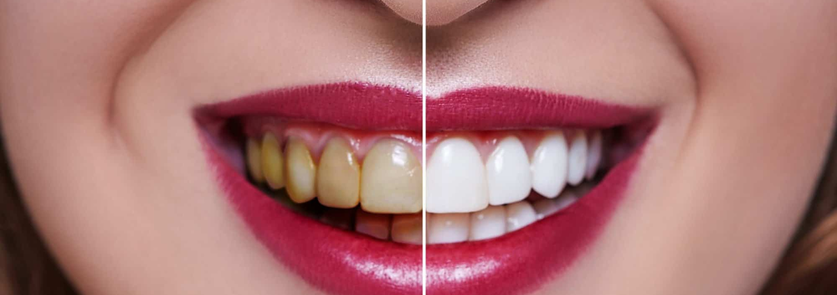 Teeth Whitening: How it Works and What it Costs