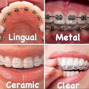 The Different Types of Braces