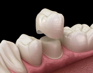 The durability of dental crowns
