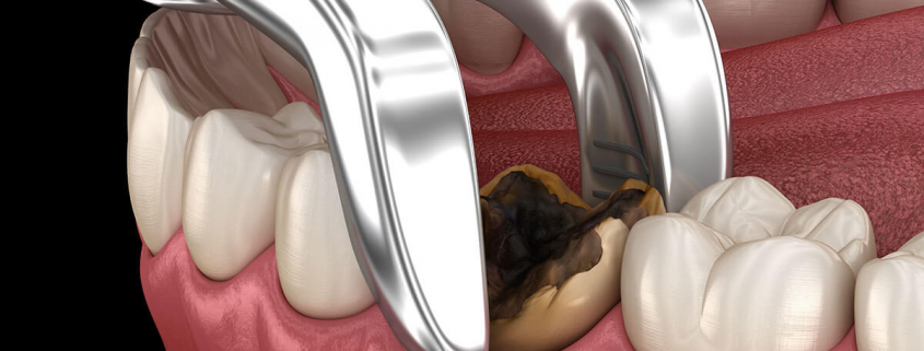 Tooth Extraction: Cost, Procedure, Risks, and Recovery