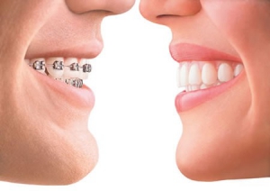 What Are the Results of Wearing Braces?