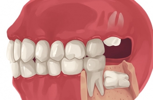 Why are teeth removed?